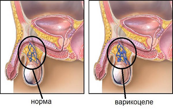 Варикоцеле